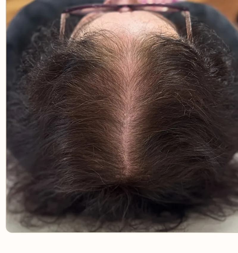 Depois: Evolução capilar, paciente feminina