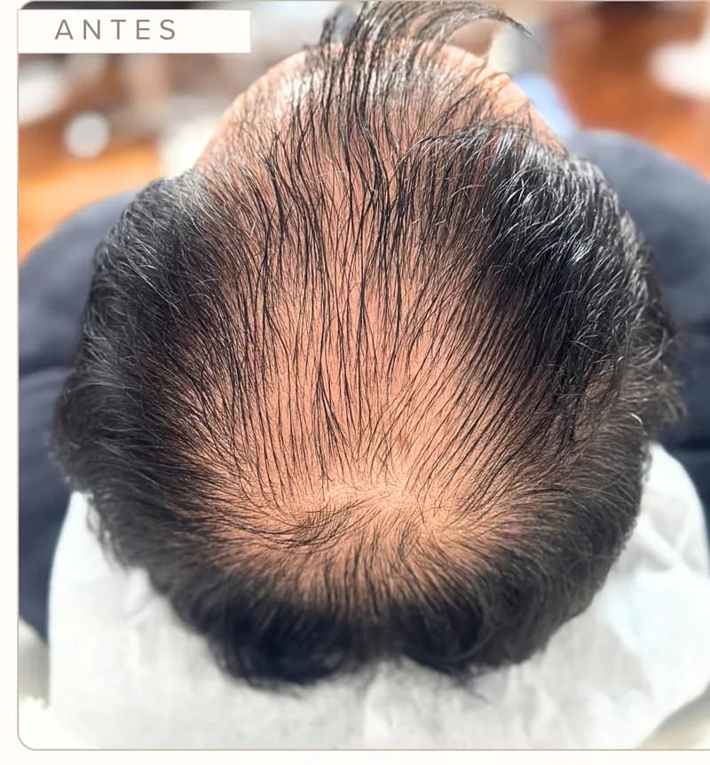 Antes: Evolução capilar, paciente masculino