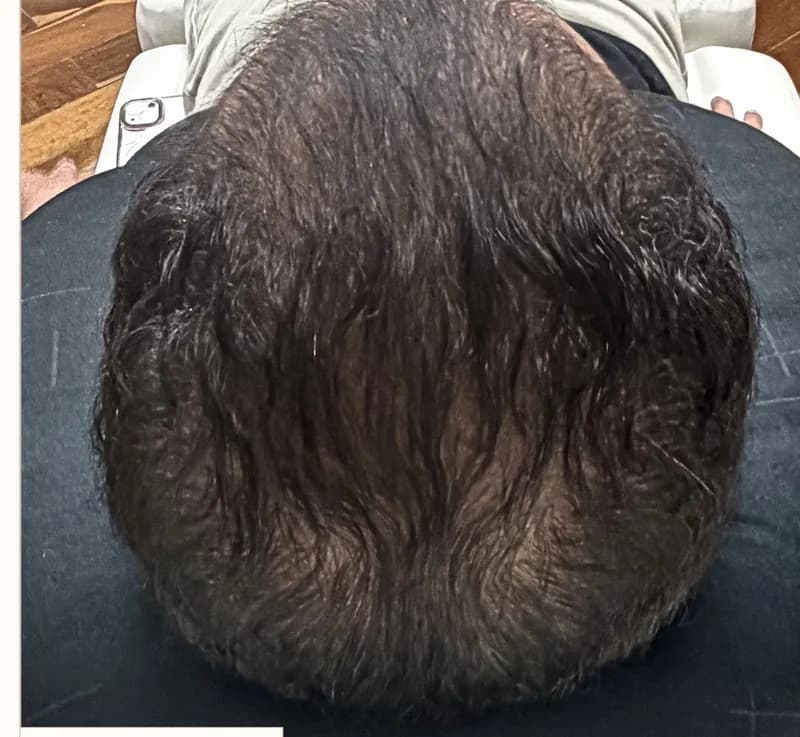 Depois: Evolução capilar, paciente masculino