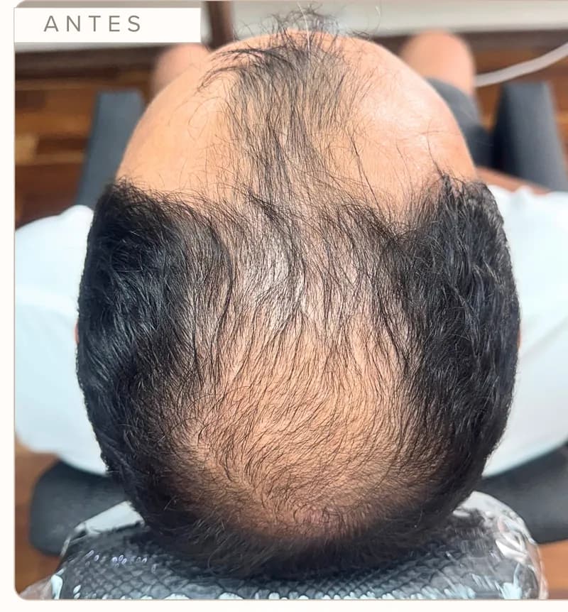 Antes: Evolução capilar, paciente masculino