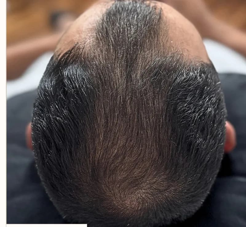 Depois: Evolução capilar, paciente masculino